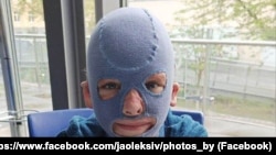 Roman Oleksiv wore a compression mask on his head and face for two years after the attack that left him with severe burns